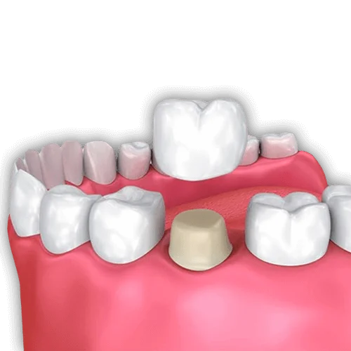 Advantages of Dental Crowns