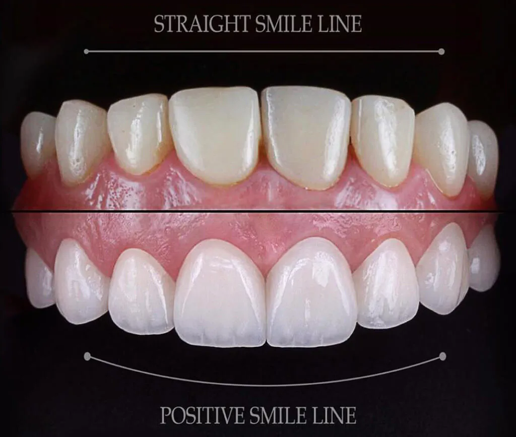 Advantages of Hollywood Smile