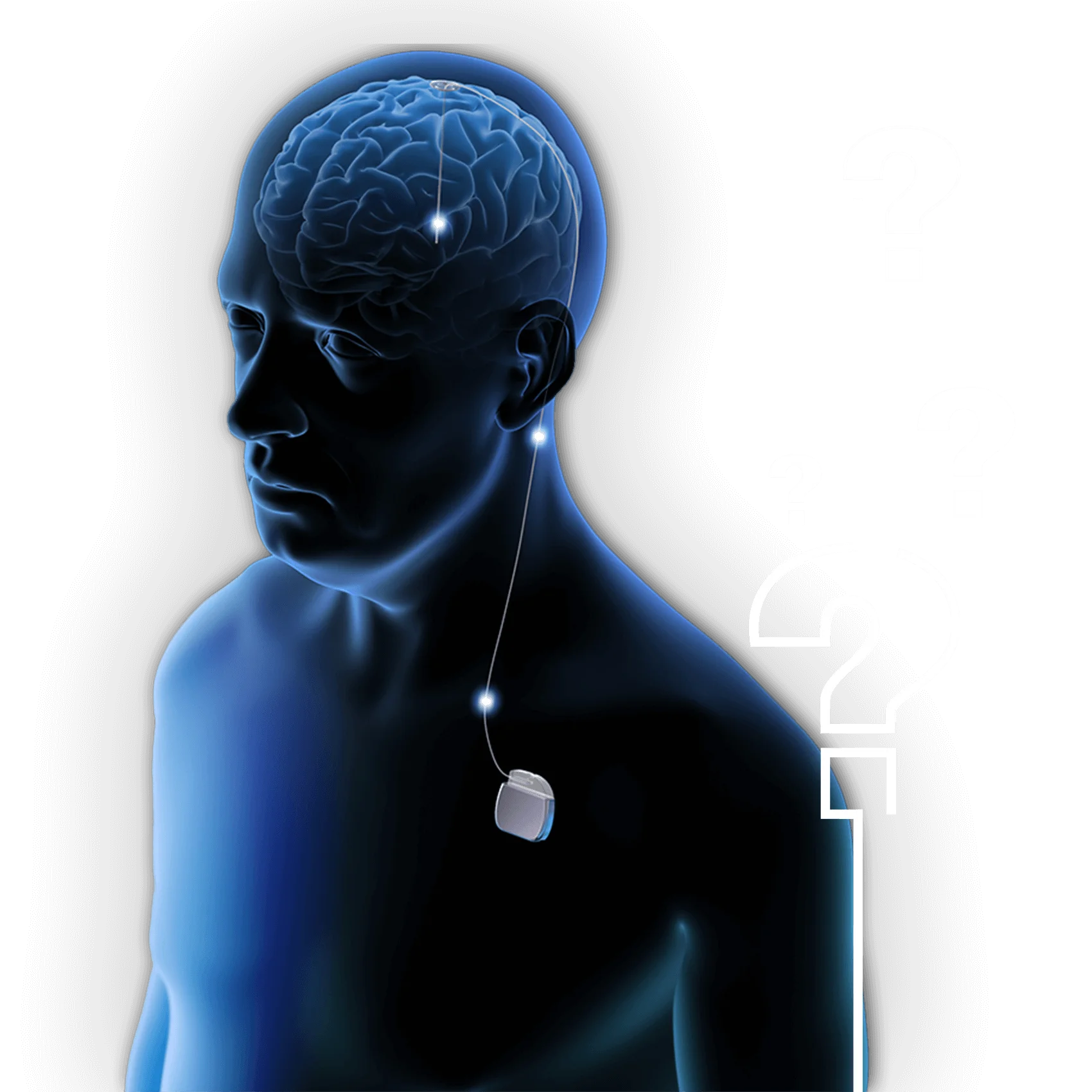 How Much Does Deep Brain Stimulation Cost