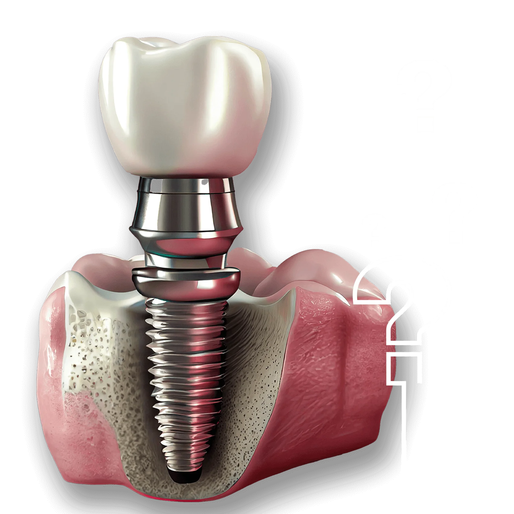 How Much Does Dental Implants Cost