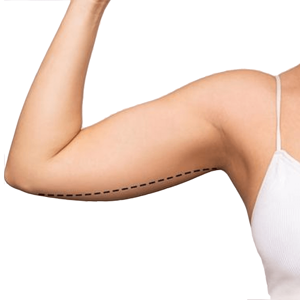 What Are Brachioplasty (Arm Lift)