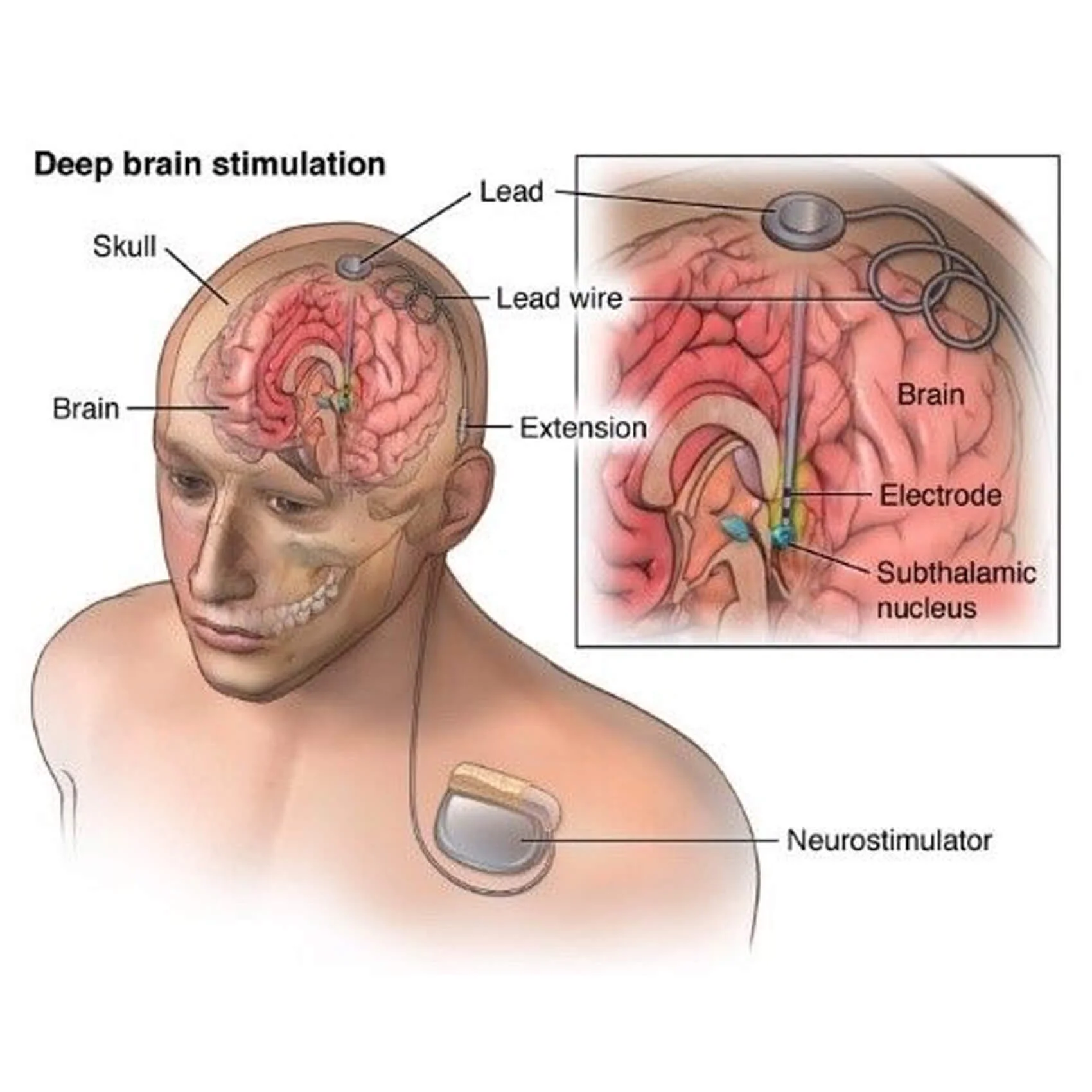 What Are Deep Brain Stimulation
