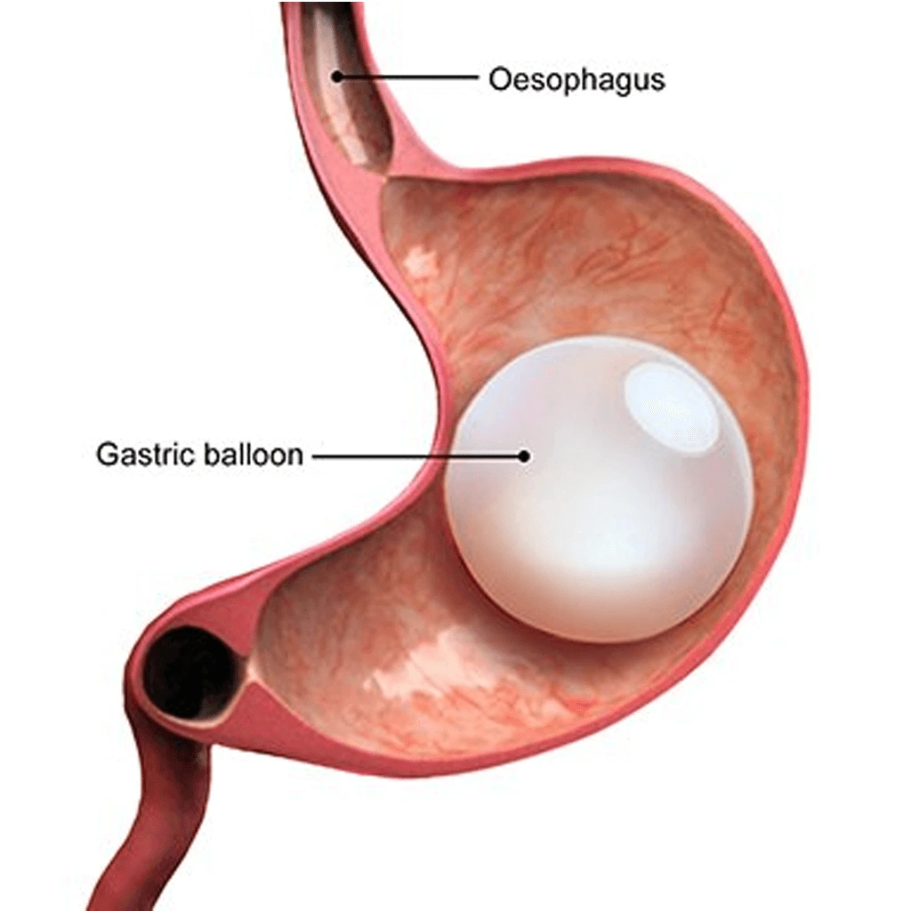 What Are Gastric Balloon