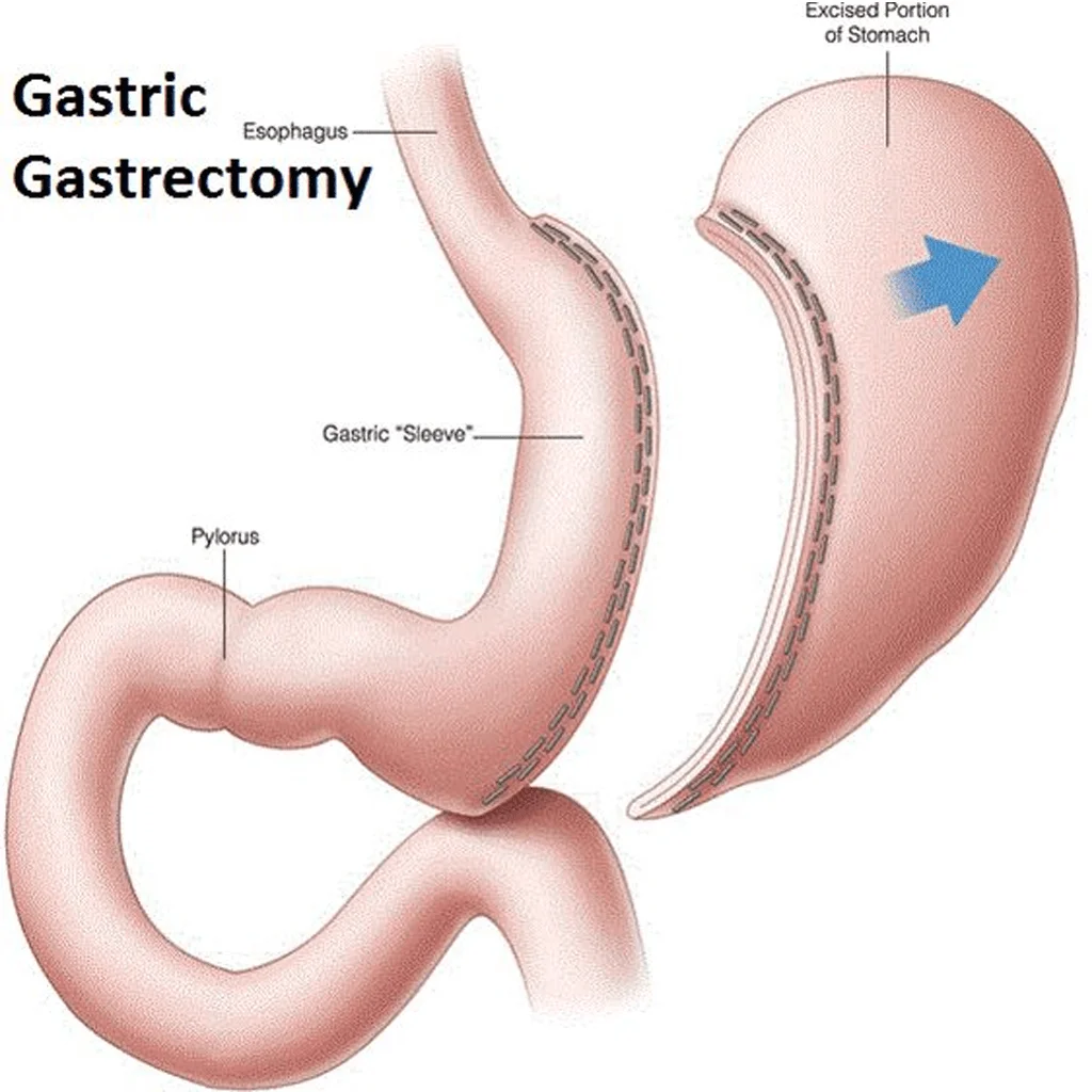 What Are Gastric Sleeve