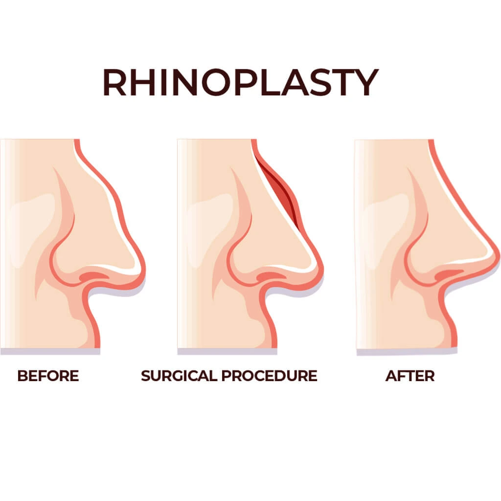 What Are Rhinoplasty