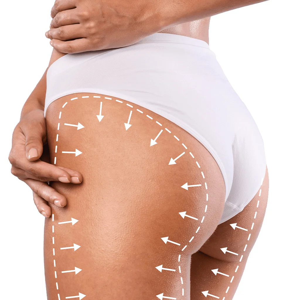 What Are Thighplasty (Inner Thigh Lifting)
