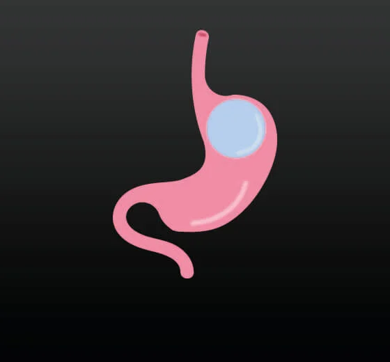 Gastric Balloon (Non-Surgical)