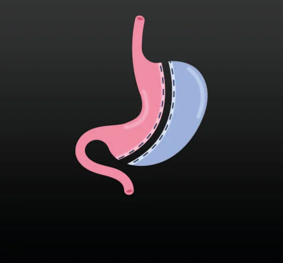 Gastric Sleeve (Surgical)