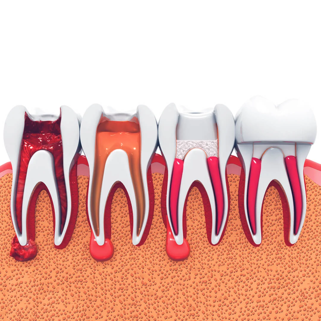 Advantages of Endodontics