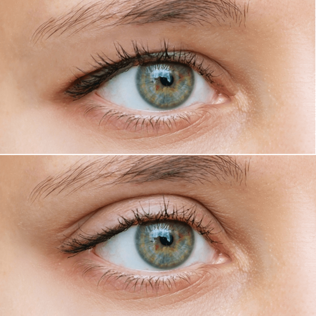 Advantages-of-Eyelid-Surgery