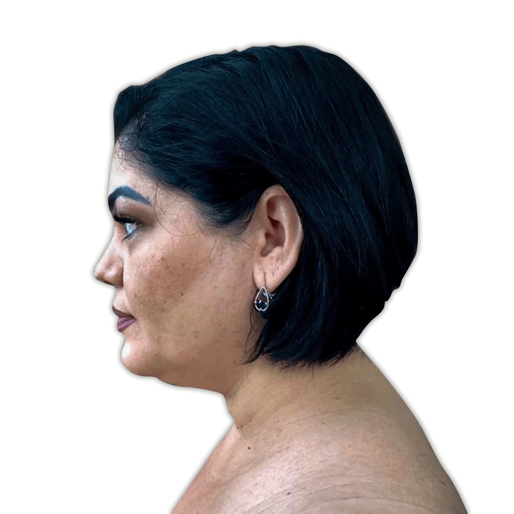 After Neck Liposuction Surgery