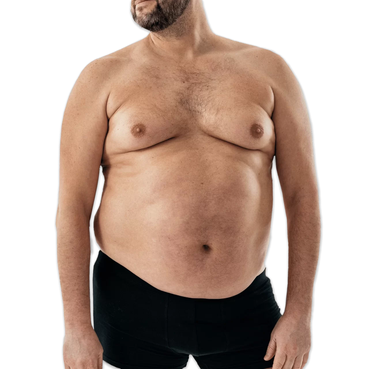 Before-Vaser-Liposuction-Surgery.webp
