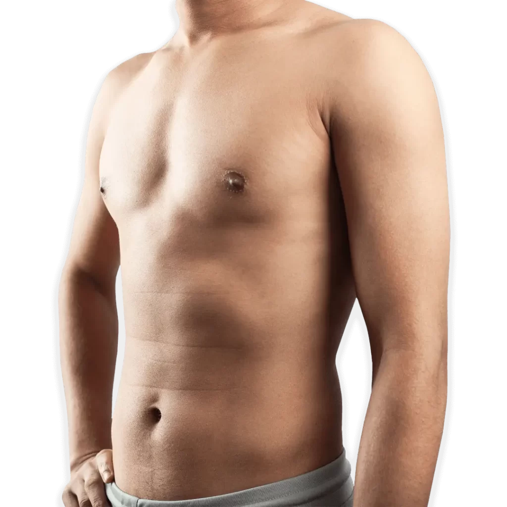 Before-Vaser-Liposuction-Surgery.webp