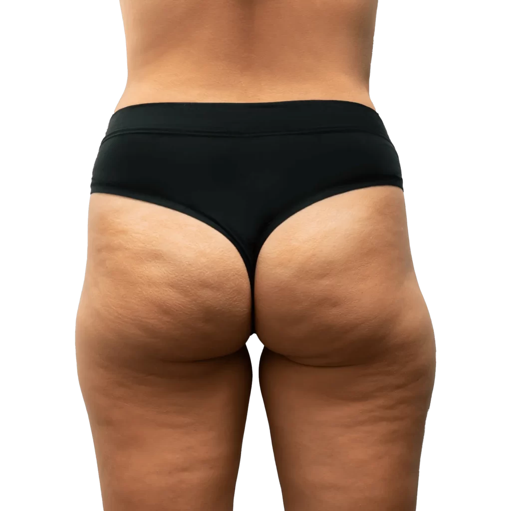 Before-Vaser-Liposuction-Surgery.webp