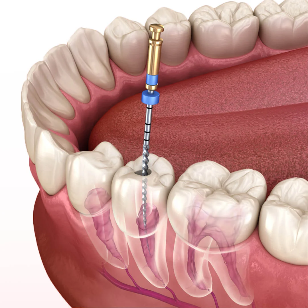 What is Endodontics