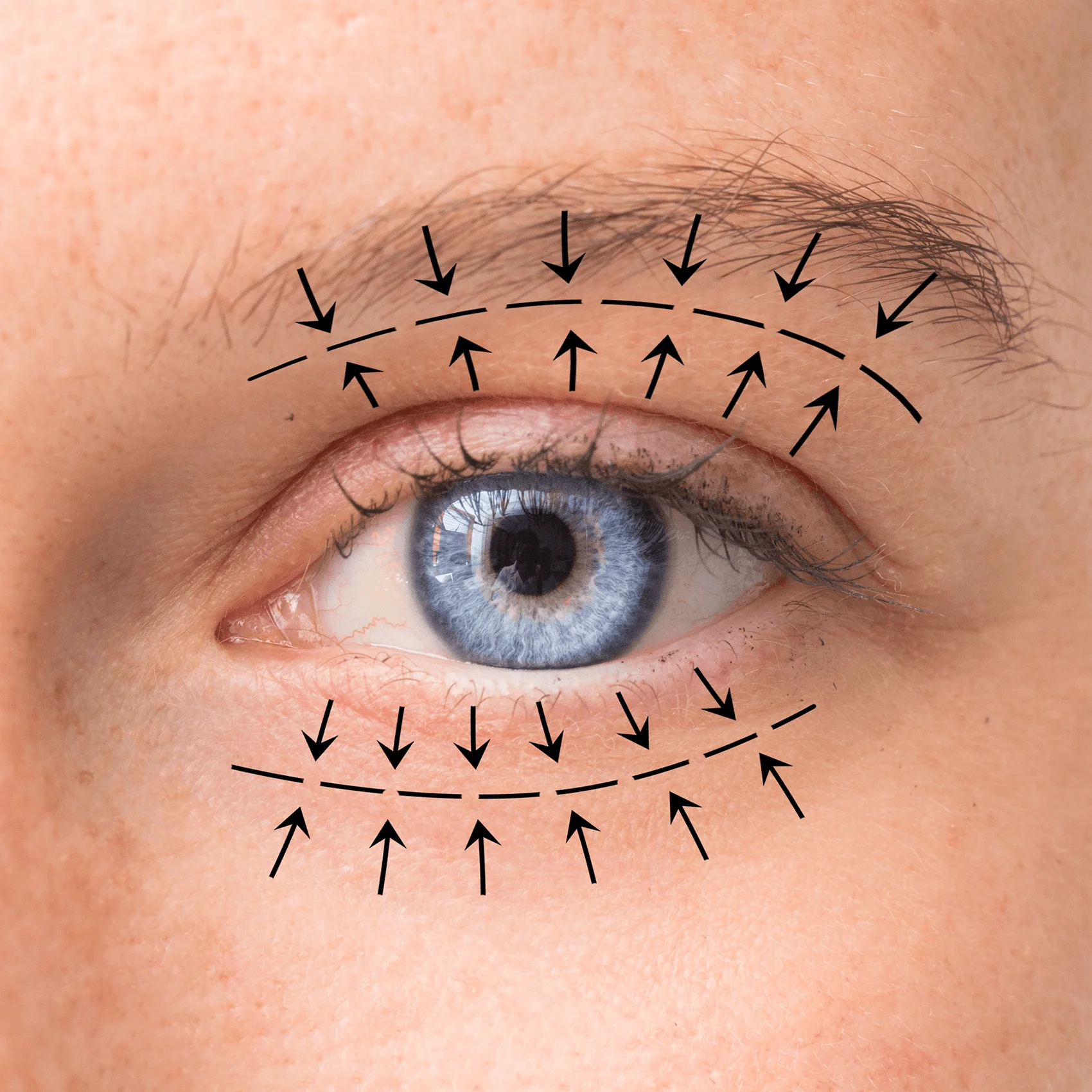 What is Eyelid Surgery