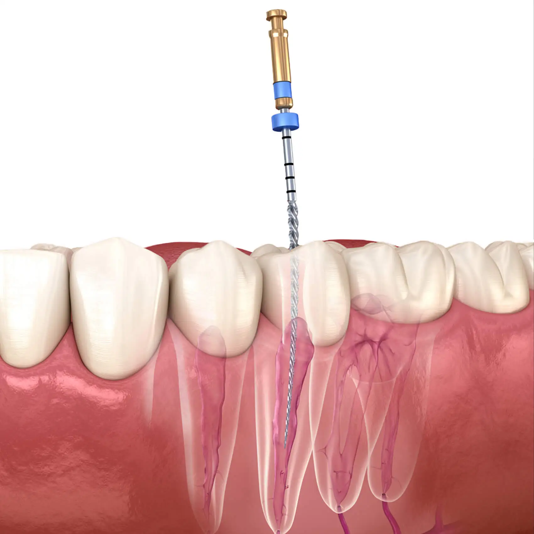 Why Choose Us for Endodontics Treatment in Istanbul, Turkey