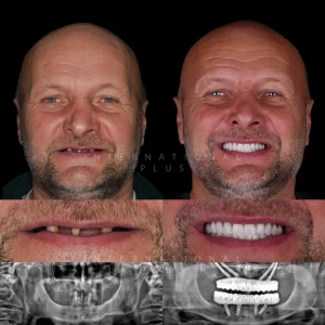 Zygomatic Implant Before After