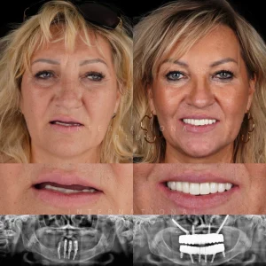 Zygomatic Implant Before After