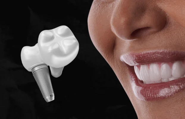 What are the best dental implant brands?