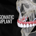 What is Zygomatic Dental Implant