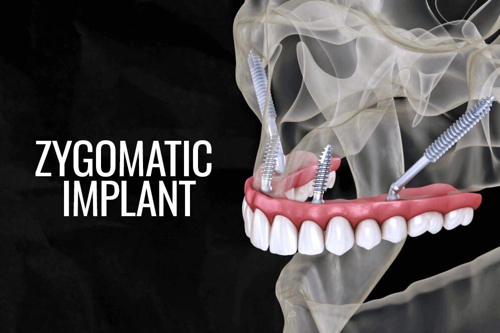 What is Zygomatic Dental Implant?
