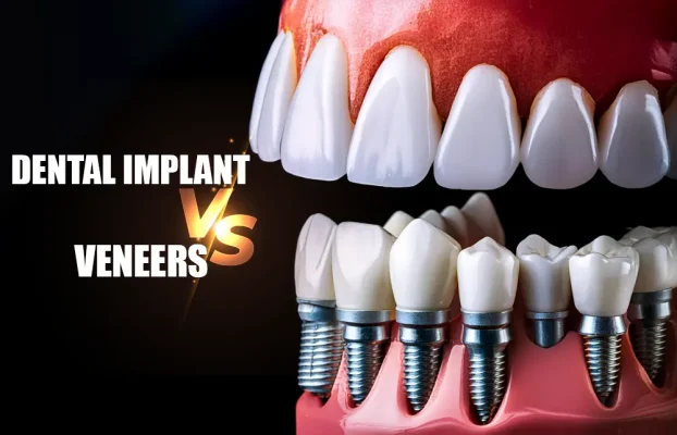 Dental Implant Vs Veneers