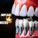 Dental Implant Vs Veneers