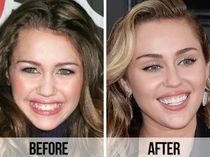 Hollywood Smile Celebrities Before And After