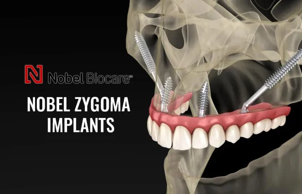 Nobel Zygoma Implants