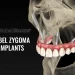 Nobel Zygoma Implants