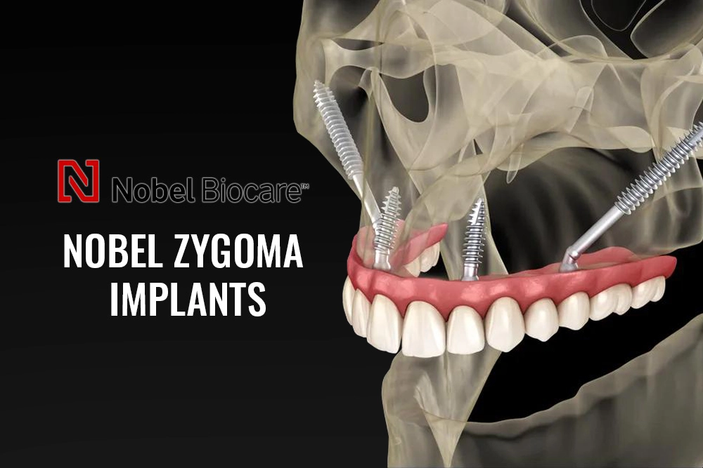 Nobel Zygoma Implants