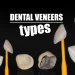 Dental Veneers Types