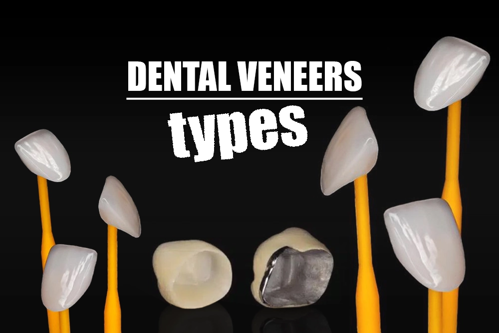 Dental Veneers Types