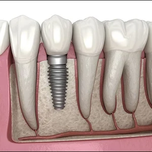 What Do Dental Implants Look Like