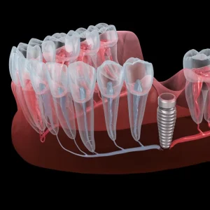 Can Dental Implants Be Removed