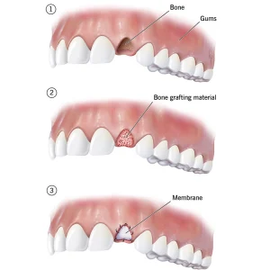 A Comprehensive GuideFor Dental Implants 