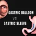 Gastric Balloon Vs Gastric Sleeve