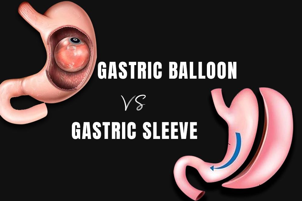 Gastric Balloon Vs Gastric Sleeve