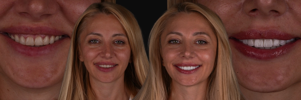 Hollywood Smile Before and After