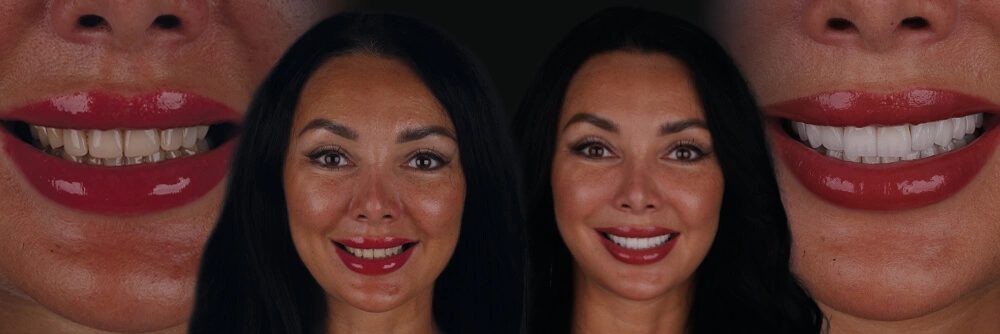 Hollywood-Smile-Without-Veneers