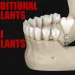 Traditional Implants Vs Mini Implants