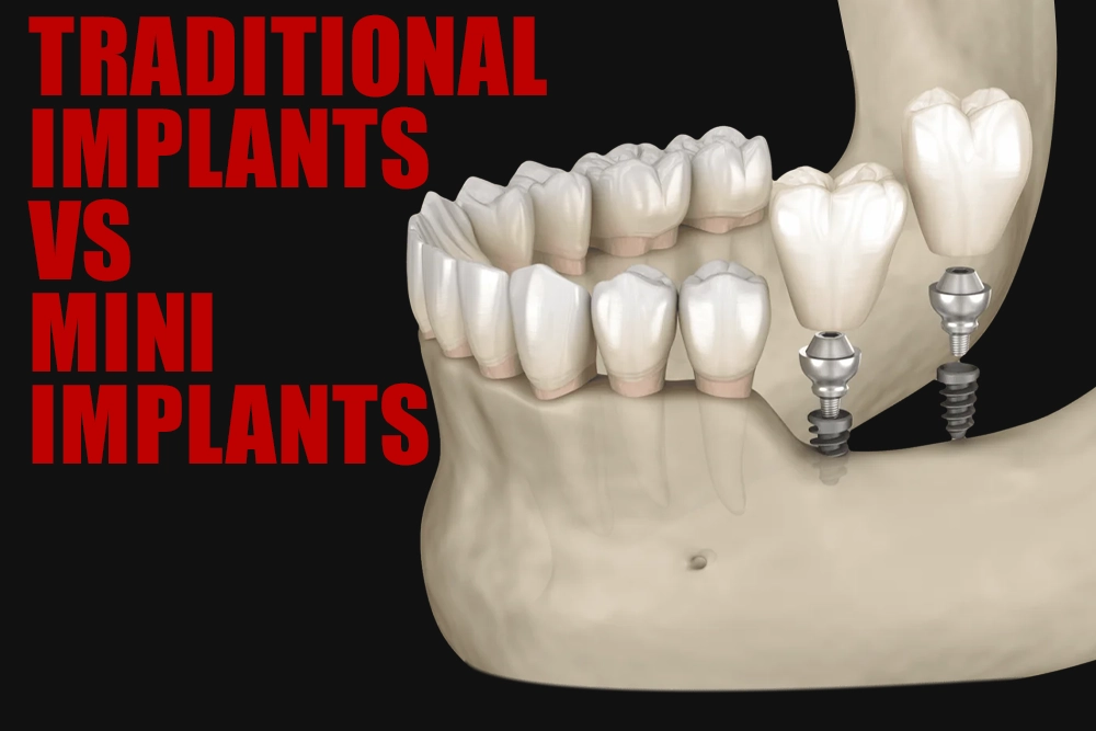 Traditional Implants Vs Mini Implants