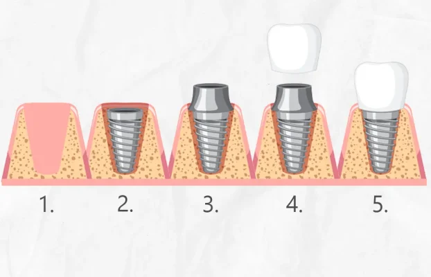 Dental Implant Healing Stages