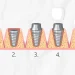 Dental Implant Healing Stages