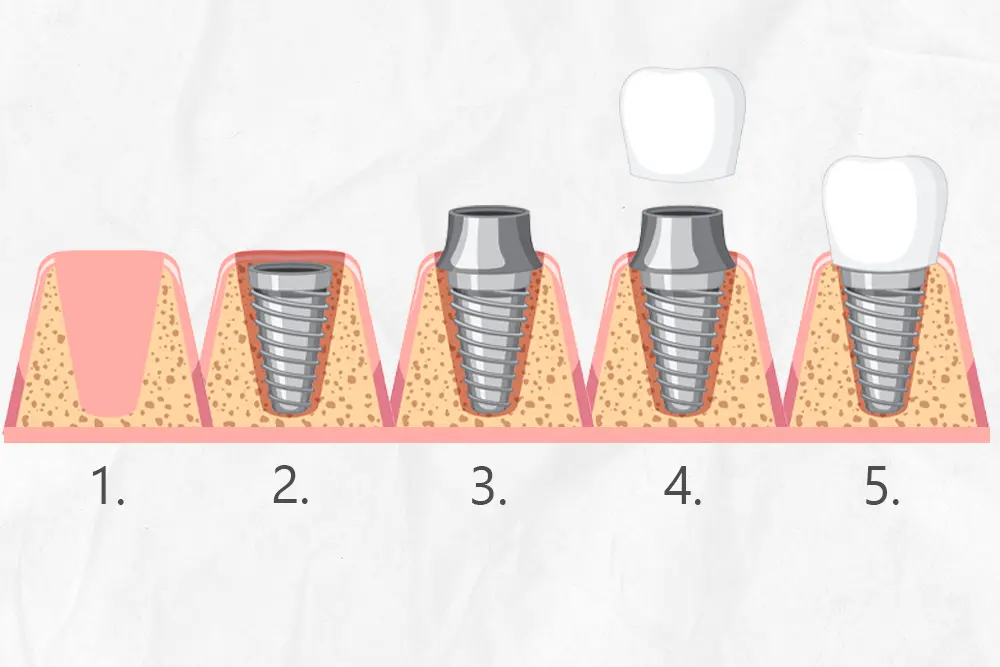 Dental Implant Healing Stages