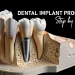 Dental Implant Process Step By Step