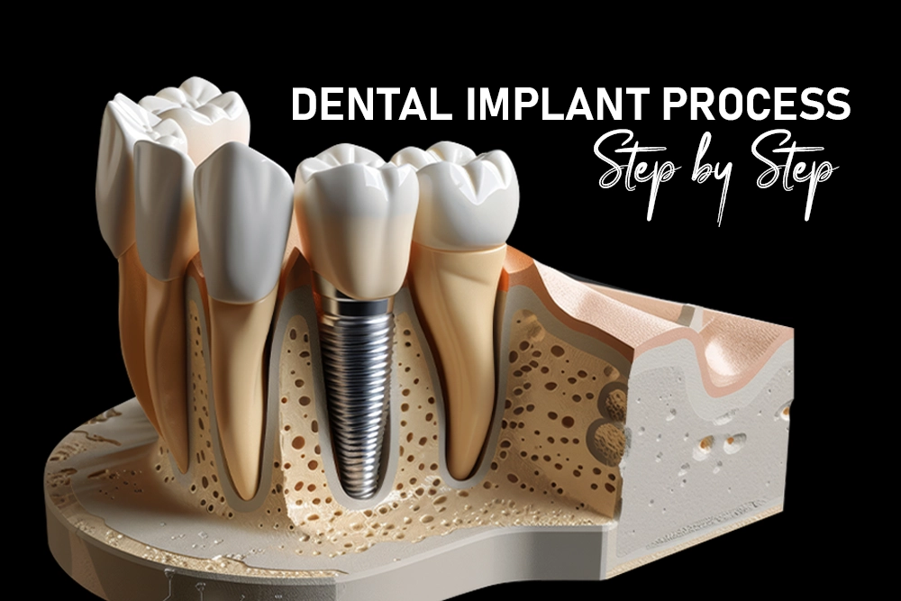 Dental Implant Process Step By Step