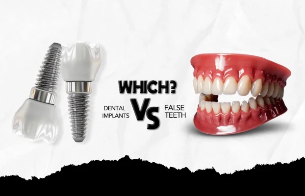 Dental Implants Vs False Teeth