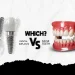 Dental Implants Vs False Teeth